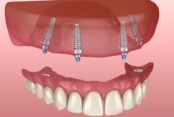 Hàm giả tháo lắp trên implant thực hiện tại nha khoa Úc Châu, bác sĩ Hoàng Anh